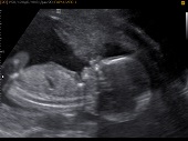 УЗИ фото при беременности, фото плода 2 триместр 17 недель