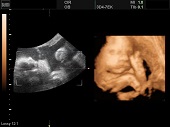 УЗИ фото при беременности, фото плода 3 триместр 31 неделя