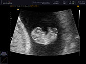 УЗИ фото при беременности, фото плода 1 триместр 9 недель
