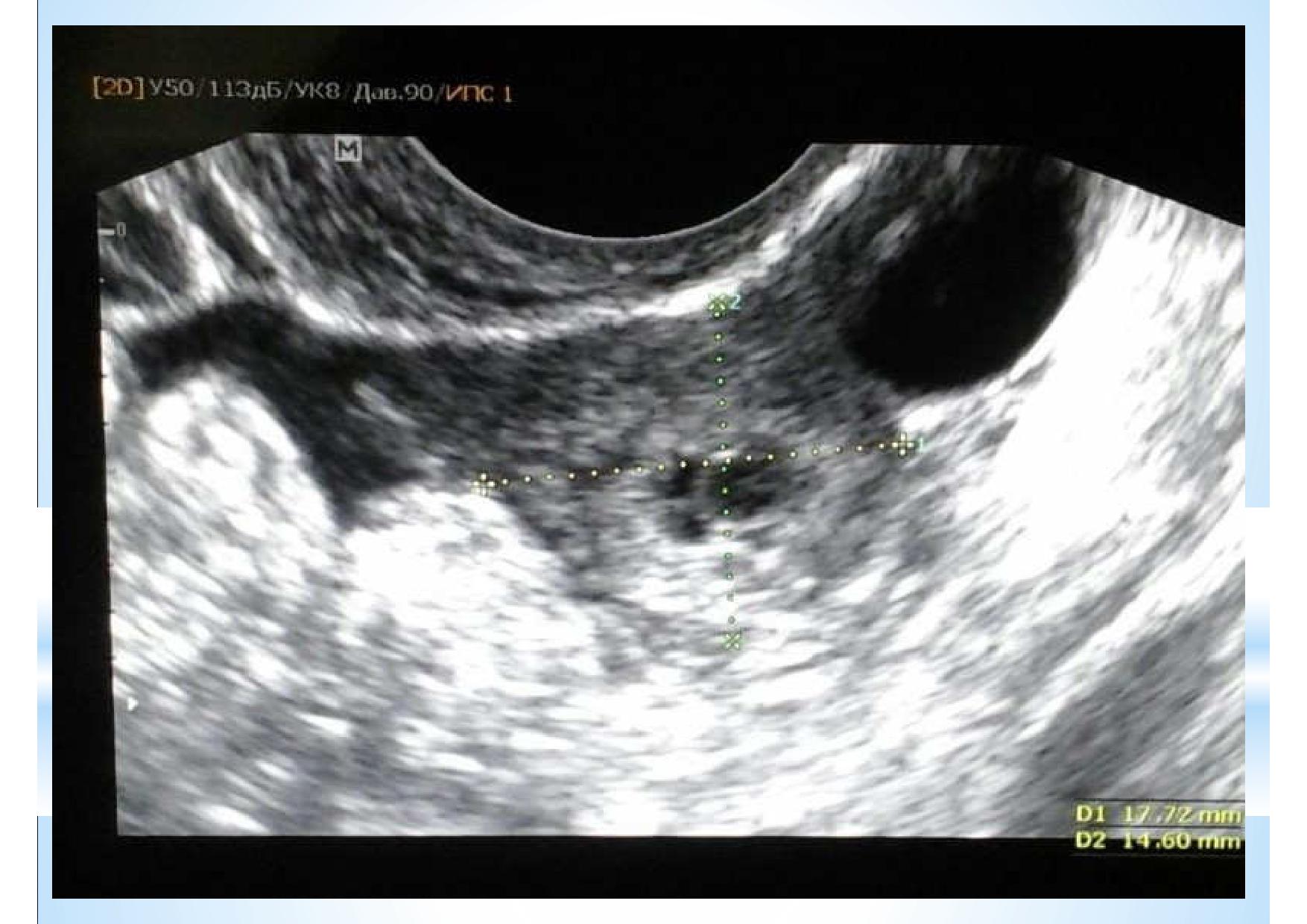 Внематочная эндометрий. УЗИ на 4 неделе внематочная бер. Внематочная беременность на УЗИ.