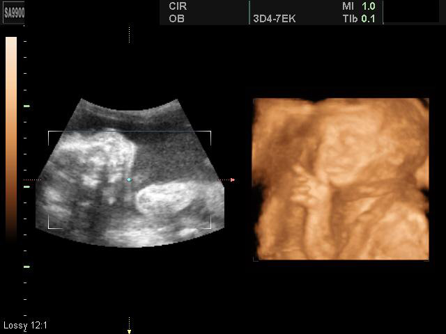 Ксс у плода. Плод 20-21 неделя беременности УЗИ. Снимок УЗИ на 21 неделе беременности. 21 Неделя беременности УЗИ 2д.