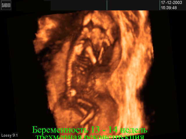 Мальчик 20 недель беременности. УЗИ 13-14 недель беременности мальчик. 3д УЗИ на 13 неделе беременности. 3 Д УЗИ 15 недель беременности.