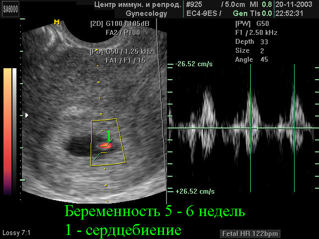 15 неделя сердцебиение