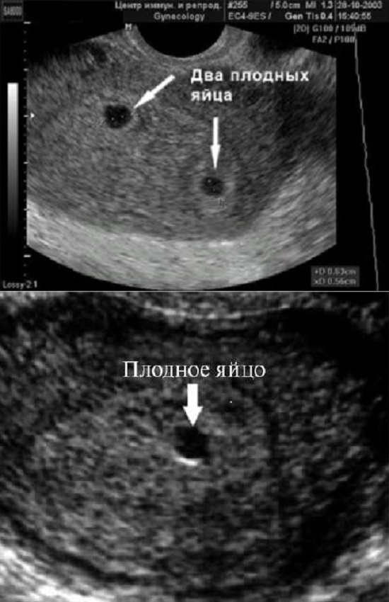 Узи 4 Недели Беременности Фото Плода