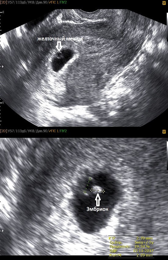 Ребёнок 14 недель беременности фото