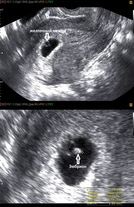 Узи 4 Недели Беременности Фото Плода