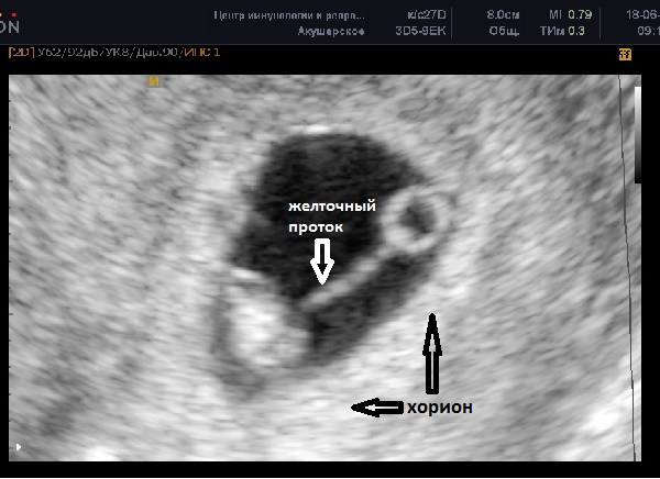 Узи 4 Недели Беременности Фото Плода