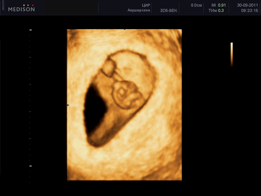 Беременность 5 Недель Узи Фото Эмбриона
