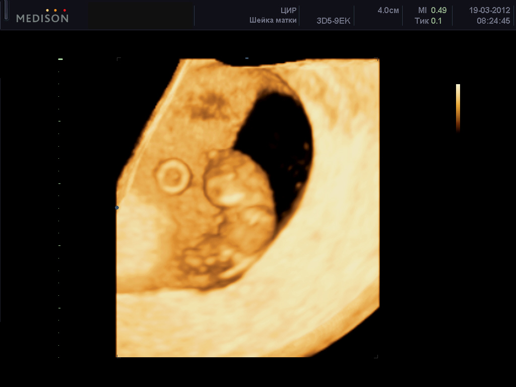 Беременность 5 Недель Узи Фото Эмбриона