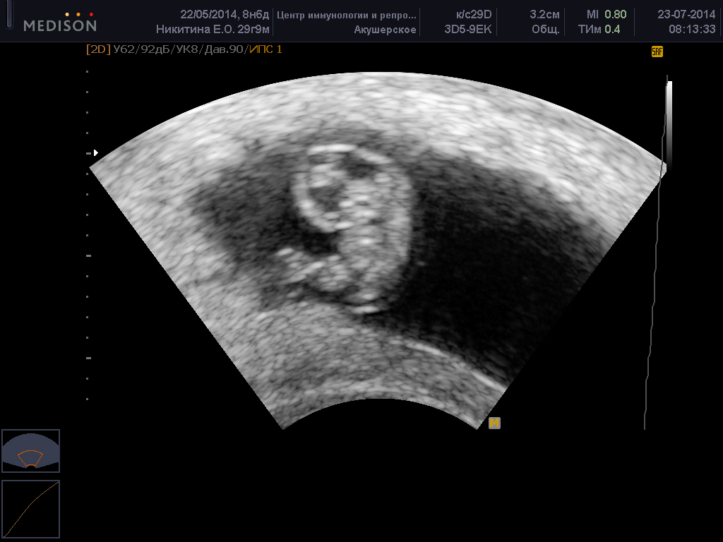 22 Неделя Беременности Фото Плода Узи