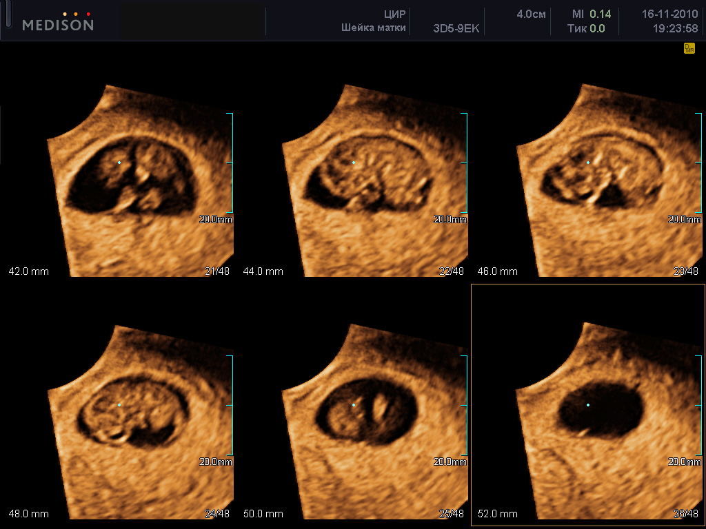 23 Недели Беременности Фото Плода На Узи