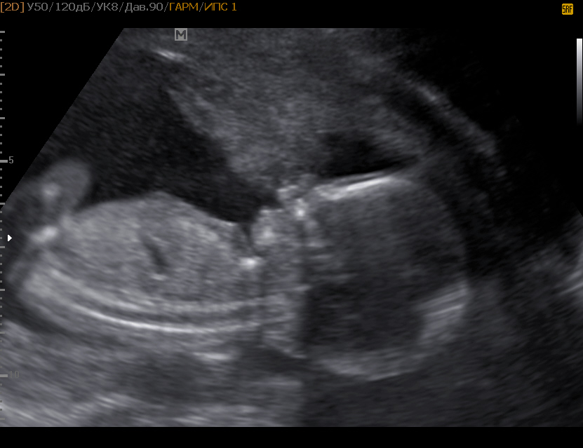 17 недель мальчик. УЗИ 16-17 недель беременности. УЗИ 17 недель беременности. Снимок УЗИ на 17 неделе беременности. Фото УЗИ беременности 16-17 недель.