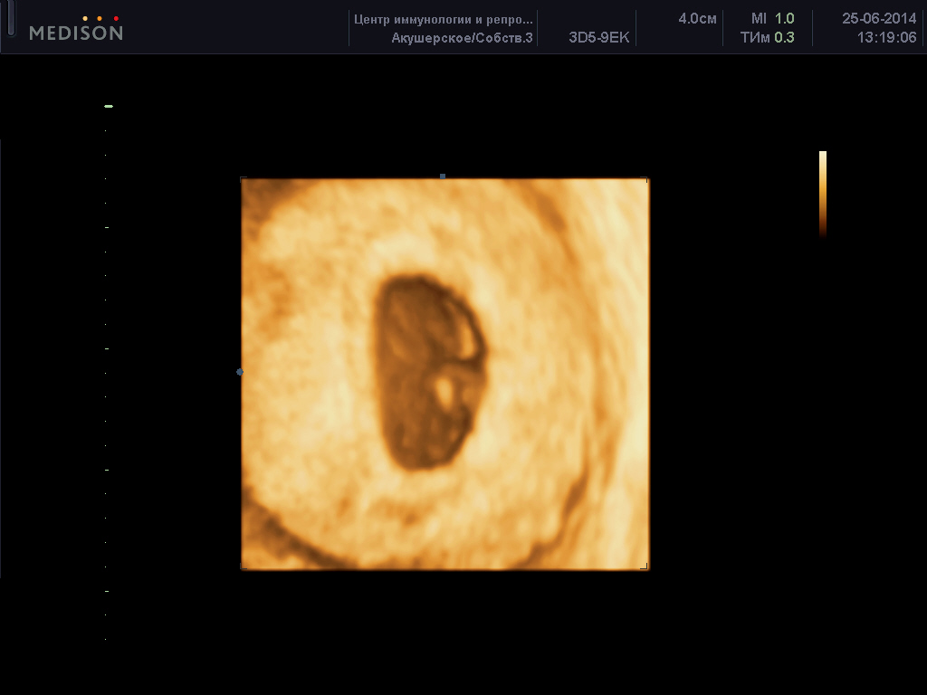 Курс 6 недель. 3д УЗИ на 6 неделе беременности. Фото эмбриона на 6 неделе беременности на УЗИ. УЗИ 3d 6 недель беременности. 7 Недель беременности 3д УЗИ.