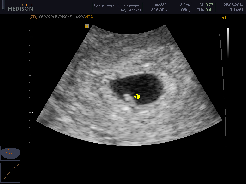 Узи На 6 Неделе Беременности Фото