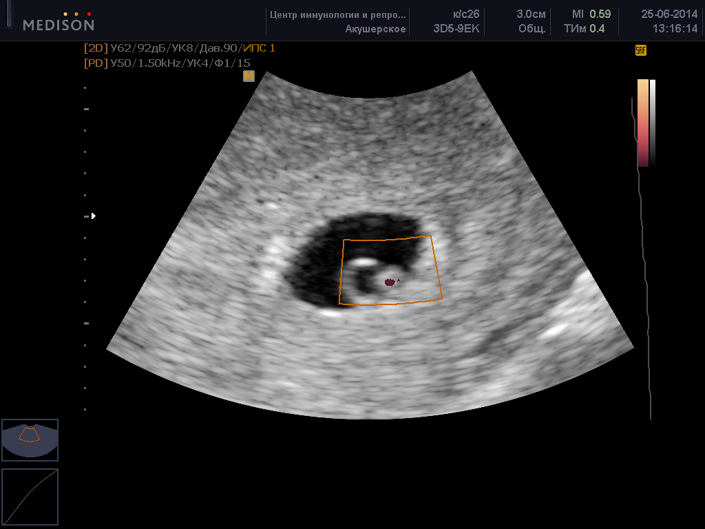 Узи Беременности Фото 6 Месяц