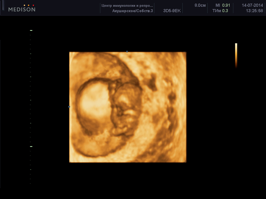 Узи плода 8 неделе. Эмбрион 8 недель снимок УЗИ. УЗИ 8-9 недель беременности. УЗИ 9 недель беременности. Фото эмбриона на 8 неделе беременности на УЗИ.