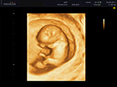 УЗИ фото при беременности, фото плода 1 триместр 10 недель