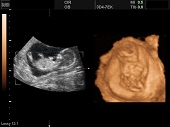 УЗИ фото при беременности, фото плода 2 триместр 13 недель