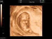 УЗИ фото при беременности, фото плода 2 триместр 13 недель
