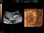УЗИ фото при беременности, фото плода 2 триместр 14 недель