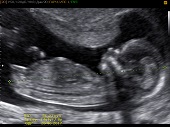 УЗИ фото при беременности, фото плода 2 триместр 15 недель