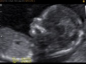 УЗИ фото при беременности, фото плода 2 триместр 15 недель