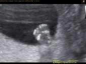УЗИ фото при беременности, фото плода 2 триместр 16 недель