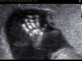 УЗИ фото при беременности, фото плода 2 триместр 17 недель