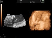 УЗИ фото при беременности, фото плода 2 триместр 18 недель