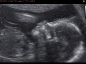 УЗИ фото при беременности, фото плода 2 триместр 20 недель