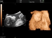 УЗИ фото при беременности, фото плода 2 триместр 20 недель