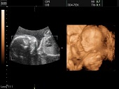 УЗИ фото при беременности, фото плода 2 триместр 21 неделя