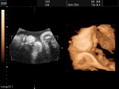 УЗИ фото при беременности, фото плода 2 триместр 29 недель