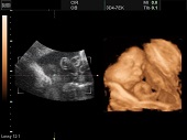 УЗИ фото при беременности, фото плода 3 триместр 30 недель