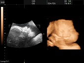 УЗИ фото при беременности, фото плода 3 триместр 32 недели