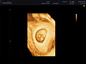 УЗИ фото при беременности, фото плода 1 триместр 6 недель
