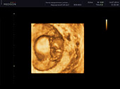 УЗИ фото при беременности, фото плода 1 триместр 8-9 недель