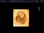 УЗИ фото при беременности, фото плода 1 триместр 8 недель