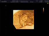 УЗИ фото при беременности, фото плода 1 триместр 8 недель