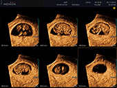 Снимок узи беременности 98