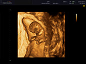 УЗИ фото при беременности, фото плода 1 триместр 9 недель