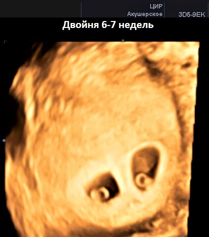 Акушерский и эмбриональный срок