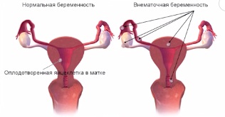 внематочная беременность.jpg