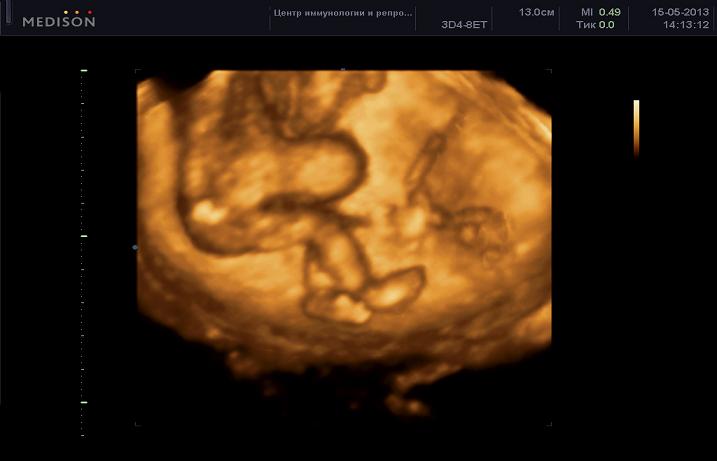 Что такое физиологическая грыжа при беременности thumbnail