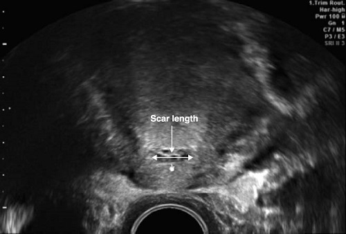 Рубец на матке узи 17