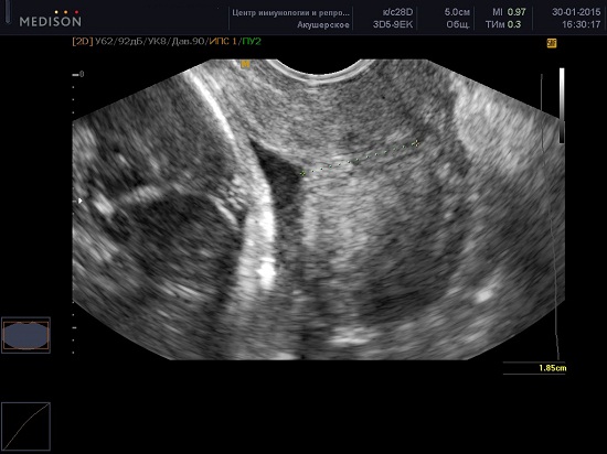 На узи видна шейка матки. Истмико-цервикальная недостаточность на УЗИ. УЗИ шейки матки цервикометрия. Цервикометрия 28 недель беременности шейка матки 30 мм.