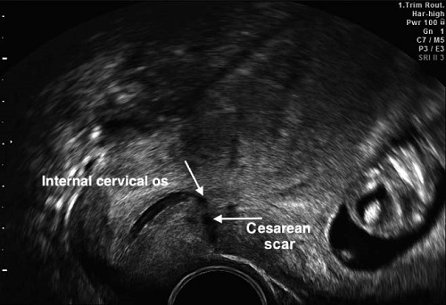Состоятельный рубец на матке после кесарева 27