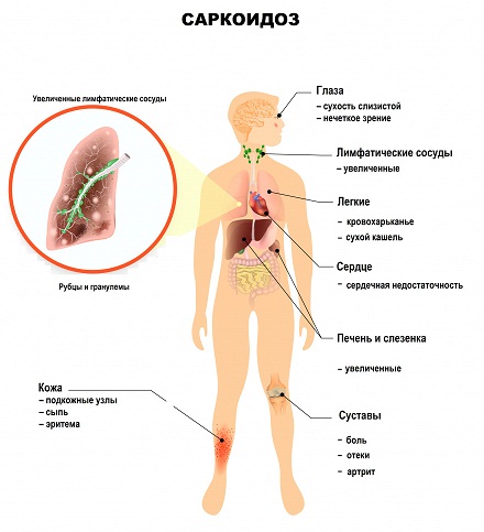 саркоидоз.jpg