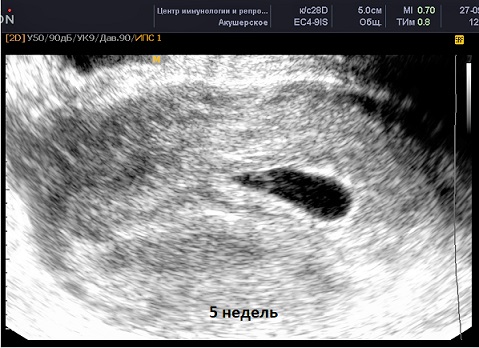 Узи 4 Недели Беременности Фото Плода