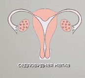 седловидная матка.jpg